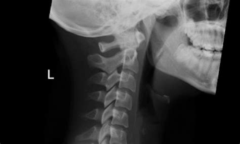 X-ray shows Irish woman with fishbone stuck in her throat