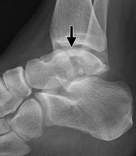 Talar Fractures and Dislocations: A Radiologist’s Guide to Timely ...