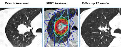 ASTRO Guideline for Stereotactic Body Radiation Therapy in Early Stage ...