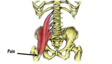 Iliopsoas Bursitis Mri