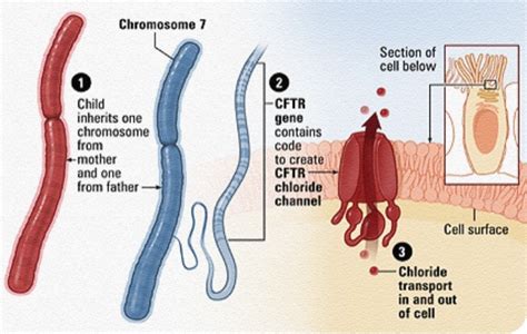 Tips for Long-Term Management of Cystic Fibrosis