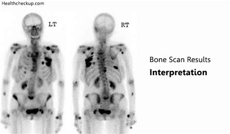 Bone Scan Results Interpretation | Bone Scan Side Effects | Health Checkup