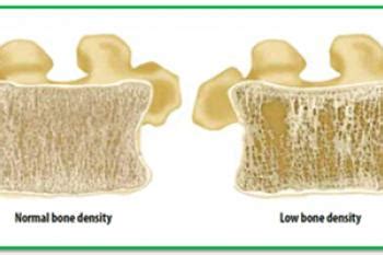 Bone Densitometry | River Radiology