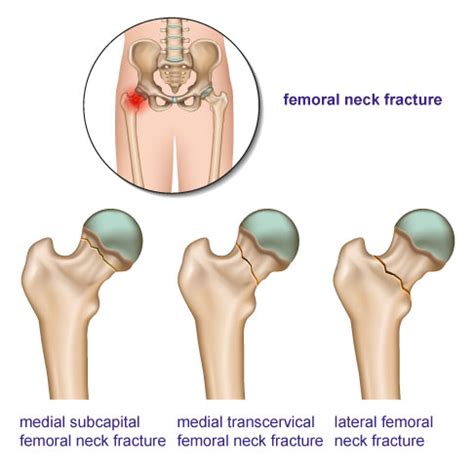 Femoral neck fractures | Joint-surgeon.com