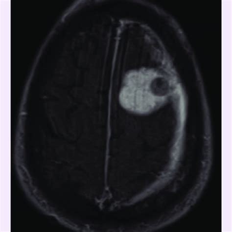 Axial T1 contrast-enhanced MRI. An axial T1 contrast-enhanced MRI image ...