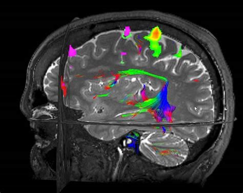 Functional Magnetic Resonance Imaging (fMRI) » Department of Neurology ...