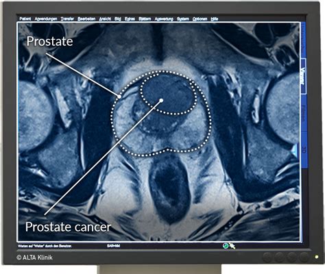 Multiparametric MRI Prostate