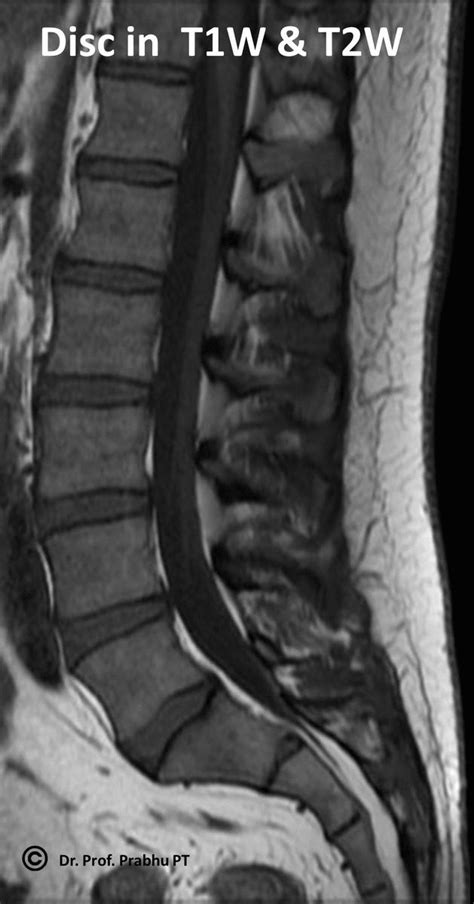 How to identify Normal Nucleus & Annulus in MRI of IVD? – Digital Teaching