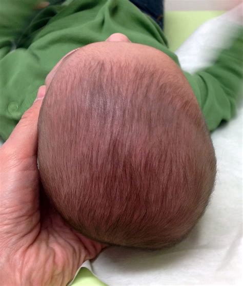 Penyebab Bayi Mengalami Plagiocephaly dan Brachycephaly - TazVita