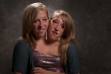 These Siamese Twins Shared Shocking News Years After They Were Born ...