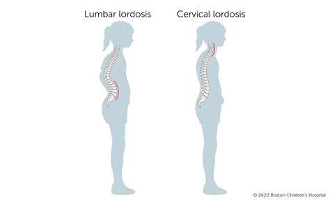 Lordosis | Boston Children's Hospital