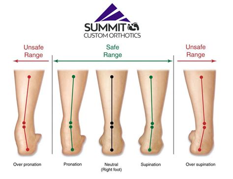 5 Benefits of Custom Foot Orthotics