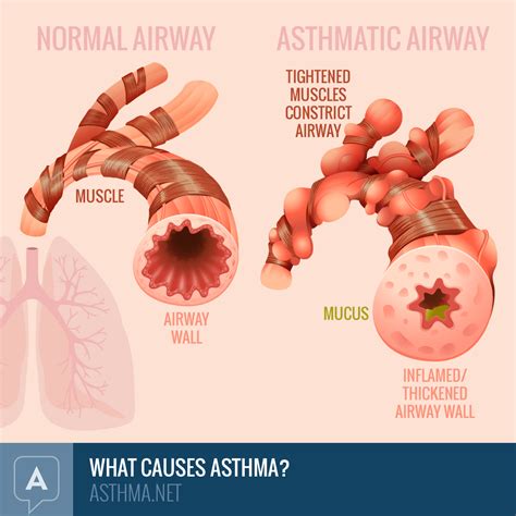 What Causes Asthma: Inflammation and Airway Narrowing