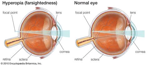 What is hyperopia? | BULB