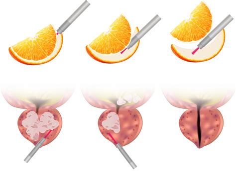 HoLEP Procedure | The Urology Group