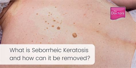 Seborrheic Keratosis removal - The Doctors Laser Clinic