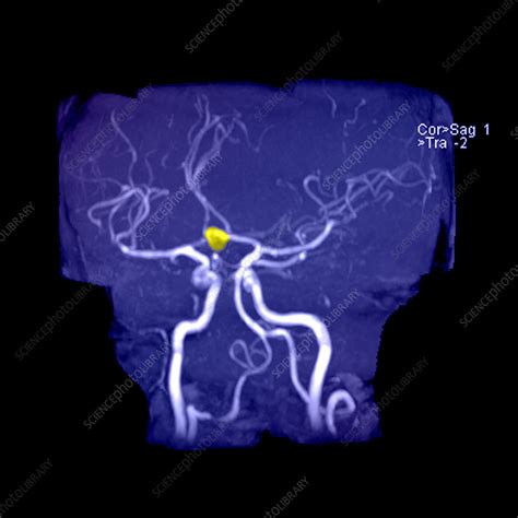 Anterior Communicating Artery Aneurysm - Stock Image - C003/4616 ...