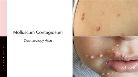 Molluscum Contagiosum - YouTube