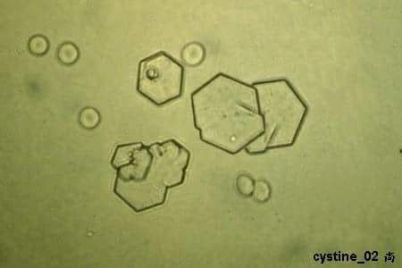 Cystine crystals | Medical laboratory, Laboratory science, Crystals