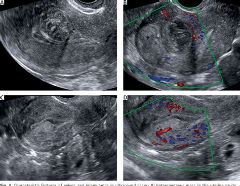 Figure 3 from Ultrasonography of uterine leiomyomas | Semantic Scholar