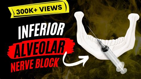 Inferior Alveolar Nerve block IANB - YouTube