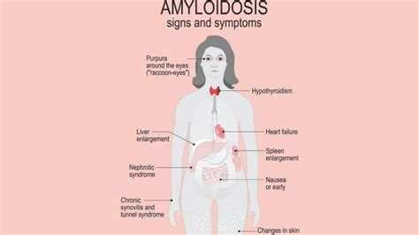 Amyloidosis: Causes, Symptoms, and Treatments | 1MD Nutrition™