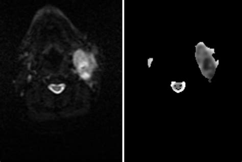 a)Diffusion restriction present on diffusion-weighted images (b= 600 ...