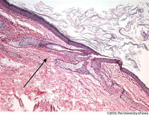 Dermoid Cyst. EyeRounds.org - Ophthalmology - The University of Iowa