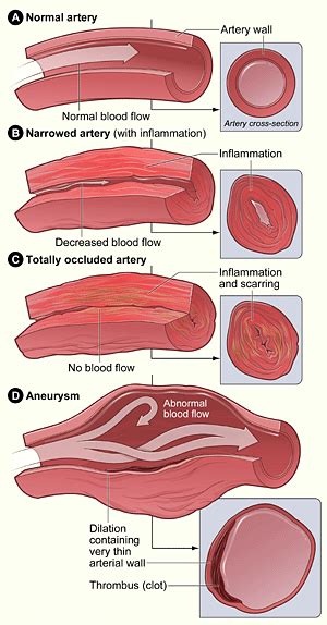 Vasculitis | NHLBI, NIH