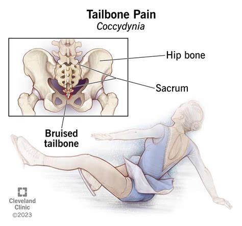 Tailbone Pain (Coccydynia): Causes, Symptoms & Treatment