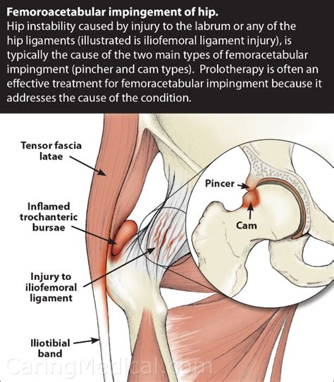 Hollywood Artisan laid pincer hip impingement treatment méditation ...