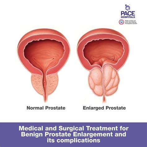 Green Light Prostate Surgery Complications | Shelly Lighting