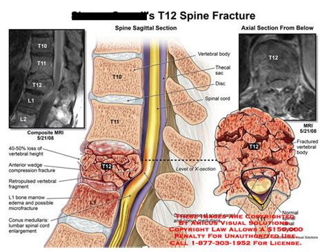 AMICUS Illustration of amicus,injury,spine,fracture,mri,T12,vertebral ...