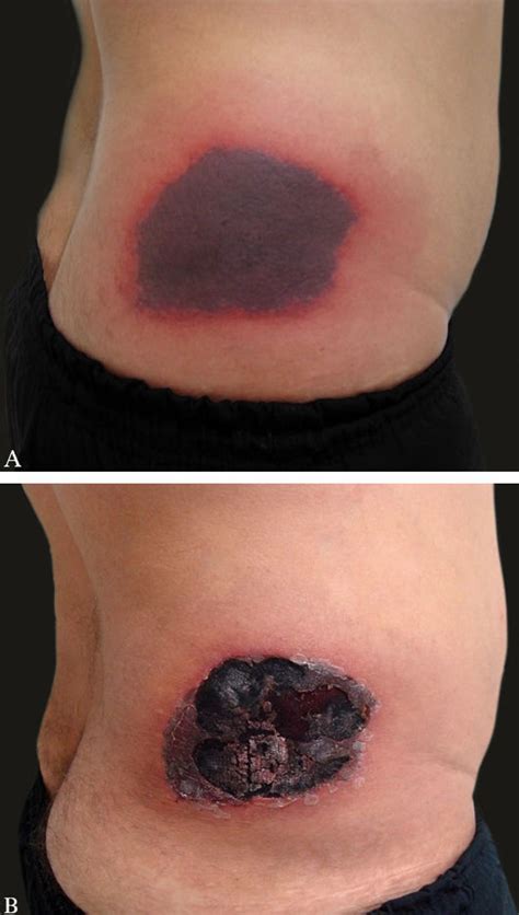 Warfarin-induced skin necrosis in a patient with protein S deficiency ...