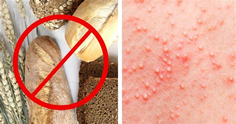 9 Signs and Symptoms That You Have a Gluten Allergy and Don't Even Know ...