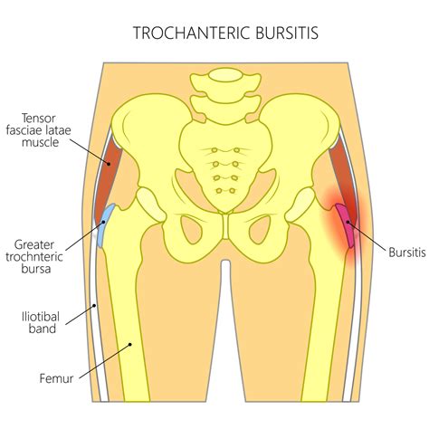 Hip Bursitis - Pro Motion Physiotherapy Thornhill