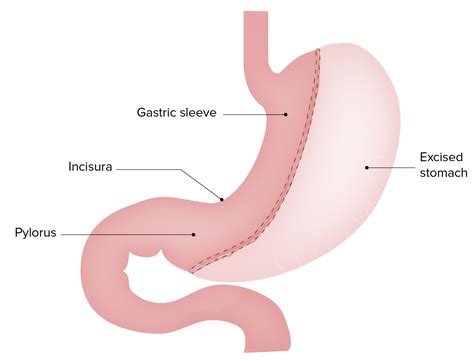 Bariatric Surgery | Concise Medical Knowledge