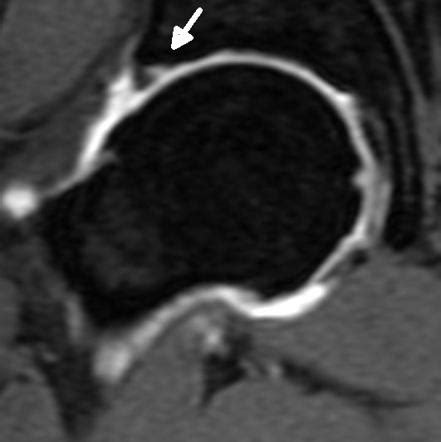 Acetabular labral tears | Radiology Reference Article | Radiopaedia.org