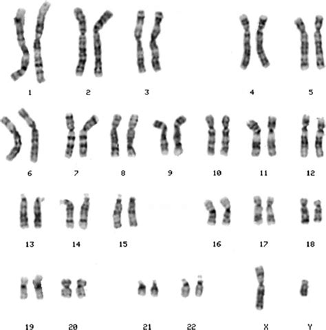 Chromosomes and Chromosomal Abnormalities | Neupsy Key