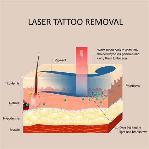 Picoway Laser Tattoo Removal Melbourne