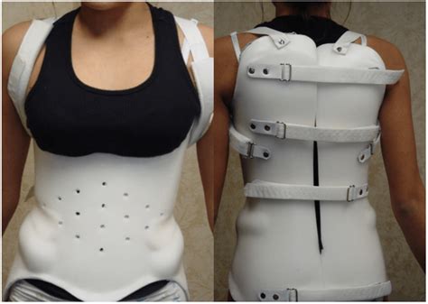 Sale > best back brace for scoliosis > in stock