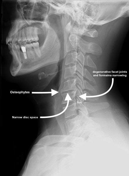 Facet Joint Syndrome - Physiopedia