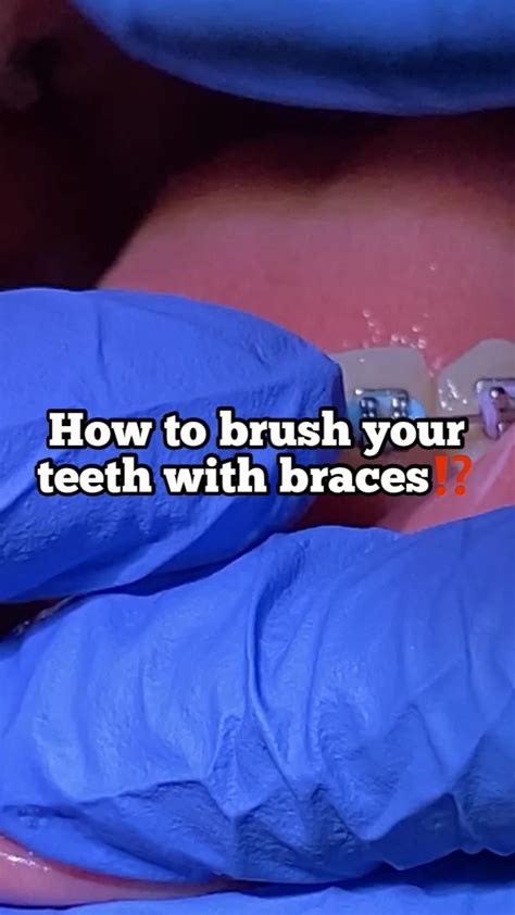 How to brush your teeth with braces? | Braces tips, Braces, Getting braces