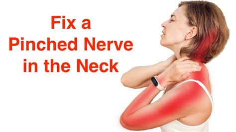 Fix a Pinched Nerve in the Neck (With FREE Exercise Sheet!) - YouTube