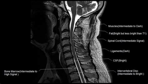 T1 vs T2 MRI | T1and T2 MRI image comparison