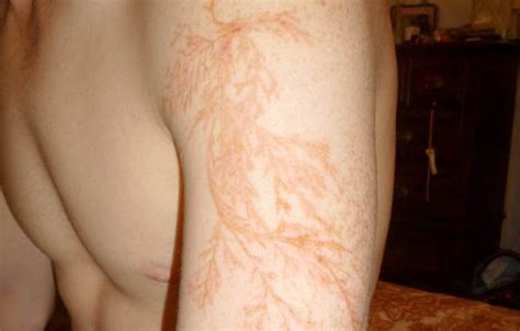 Lichtenberg Figures: The Fractal Patterns of Lightning Strike Scars ...