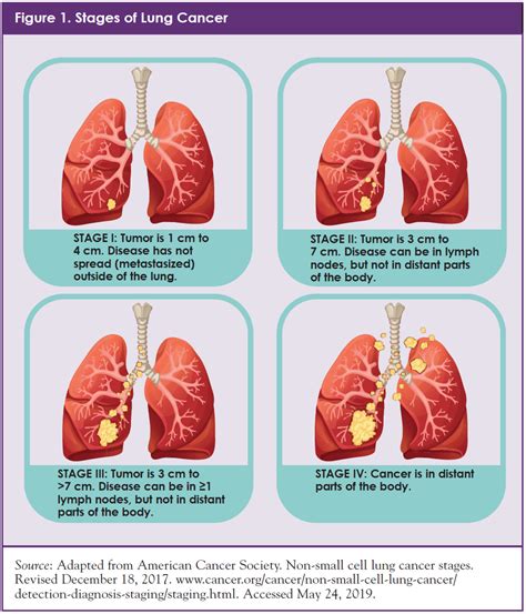 Non-Small Cell Lung Cancer - Pictures