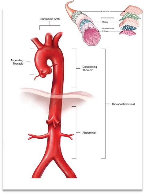 Familial Aortic Dissection Wikipedia, 49% OFF