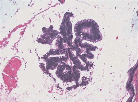 7 Histology of mucinous adenocarcinoma (MACA) of the appendix. Floating ...