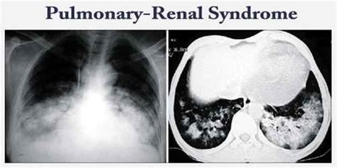 Pulmonary-Renal Syndrome - Assignment Point